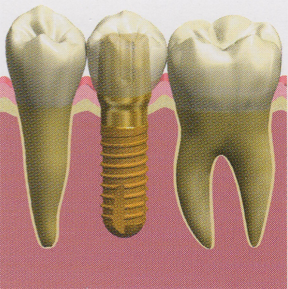 3. 人工の歯の取り付け