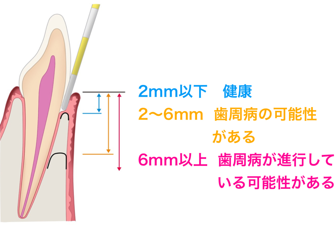 イラスト：むし歯と歯周病のチェックのイメージ