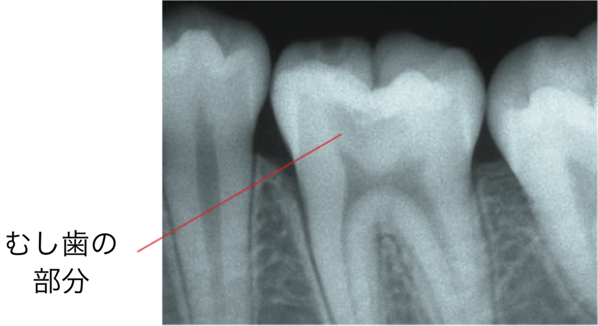 画像：むし歯