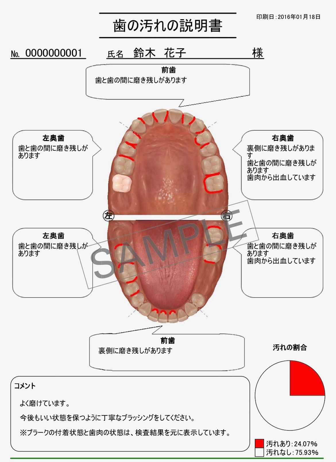 イラスト：歯の汚れの説明書