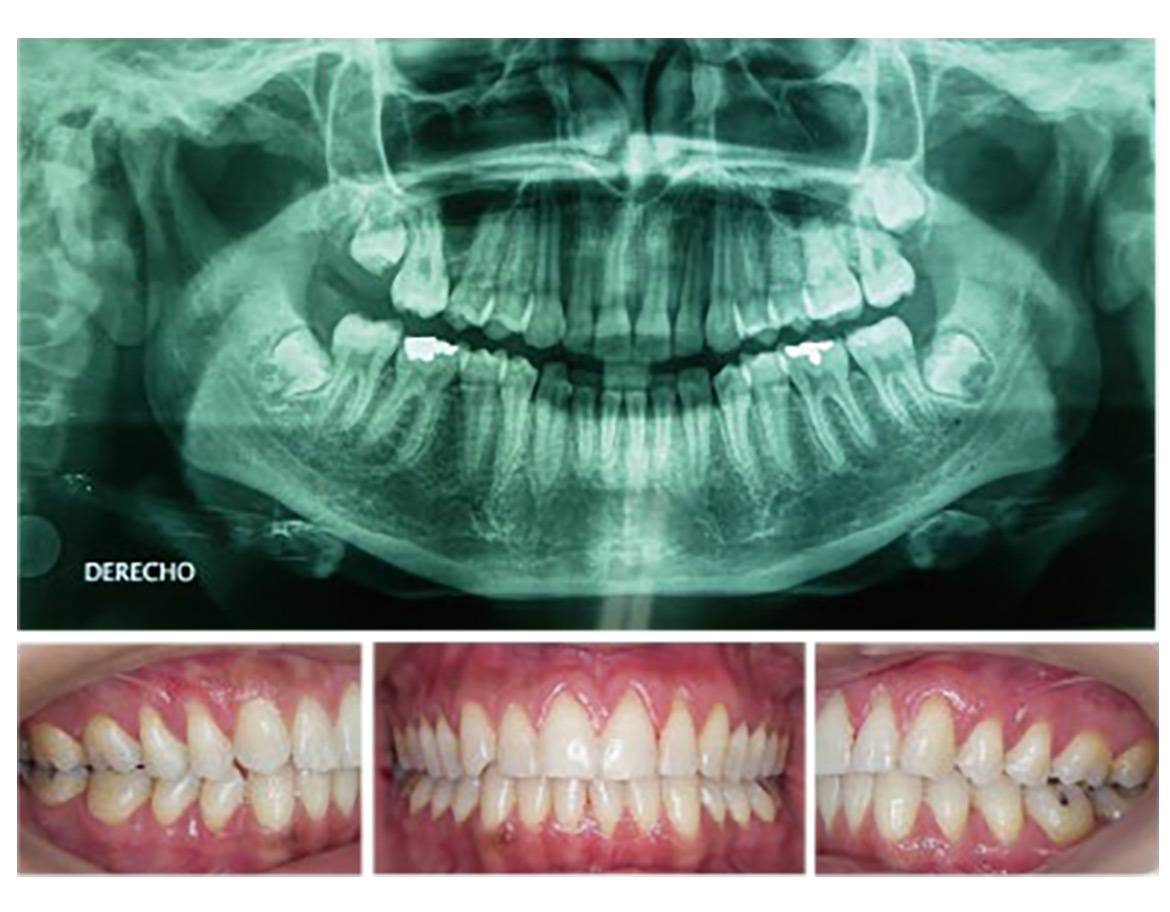 画像：歯のレントゲン画像