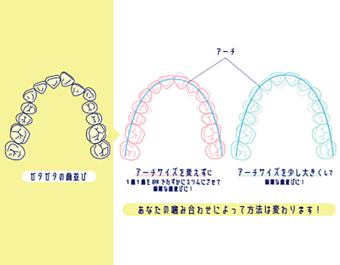 画像：ガタガタの歯並び　アーチサイズを変えずに　アーチサイズを少し大きくして　あなたの嚙み合わせによって方法は変わります！