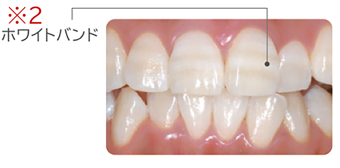 画像：ホワイトニングにおける注意点