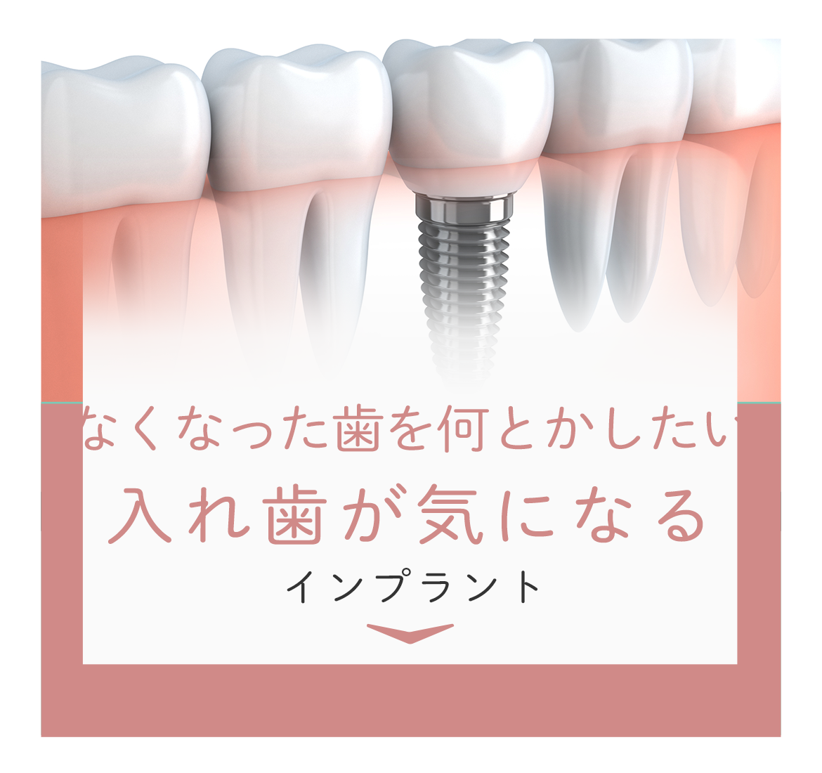 なくなった歯を何とかしたい　入れ歯が気になる　インプラント